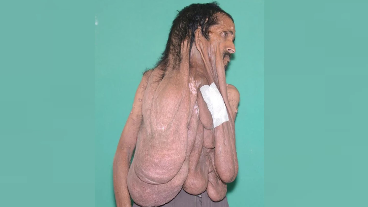 Ciudadano nepalí con un tumor facial Ciudadano nepalí con un tumor facial