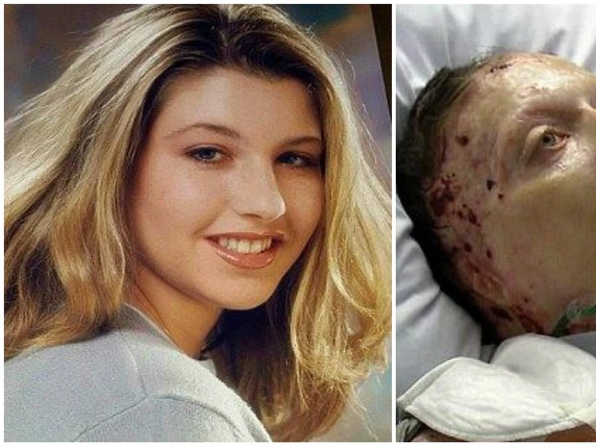 Una mujer quemada viva por su novio no puede testificar contra él: Una mujer quemada viva por su novio no puede testificar contra él: