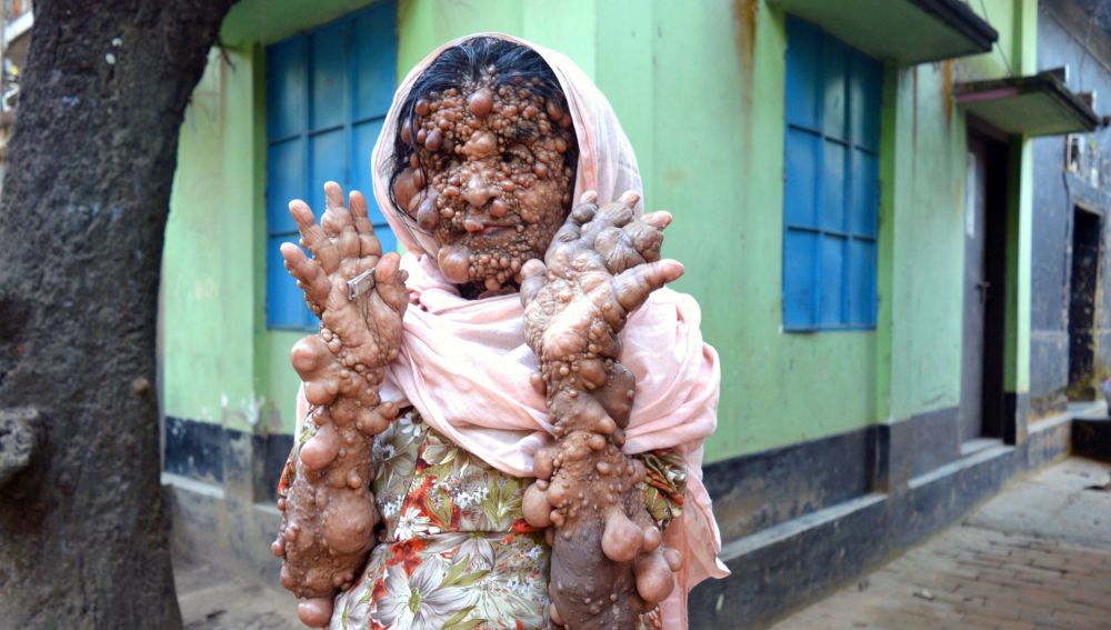 Hosineara Begum, una de las personas con más tumores del mundo