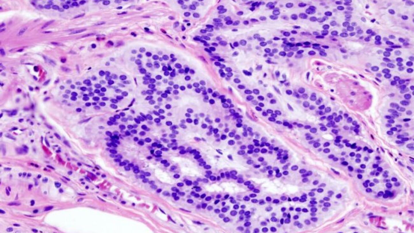 Cient&iacute;ficos espa&ntilde;oles ensayar&aacute;n en 2017 un anticuerpo humanizado contra varios tumores cancer&iacute;genos