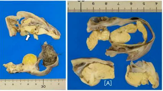 Imagen del teratoma encontrado Imagen del teratoma encontrado