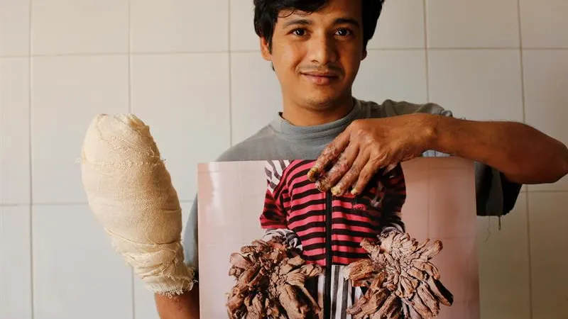El joven conocido como 'hombre árbol' de Bangladesh, Abul Bajandar El joven conocido como 'hombre árbol' de Bangladesh, Abul Bajandar