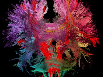 Cerebro hipercableado Cerebro hipercableado