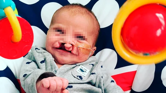 Brody, bebé con labio leporino Brody, bebé con labio leporino