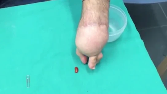 Dedos del pie transplantados a una mano Dedos del pie transplantados a una mano