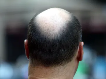 Hombre calvo Hombre calvo