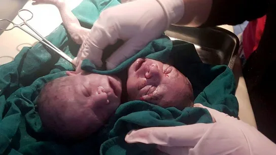 Una mujer da a luz a un bebé de dos cabezas en la India Una mujer da a luz a un bebé de dos cabezas en la India