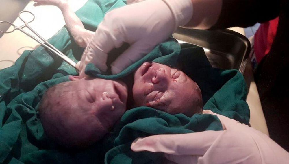 Una mujer da a luz a un bebé de dos cabezas en la India