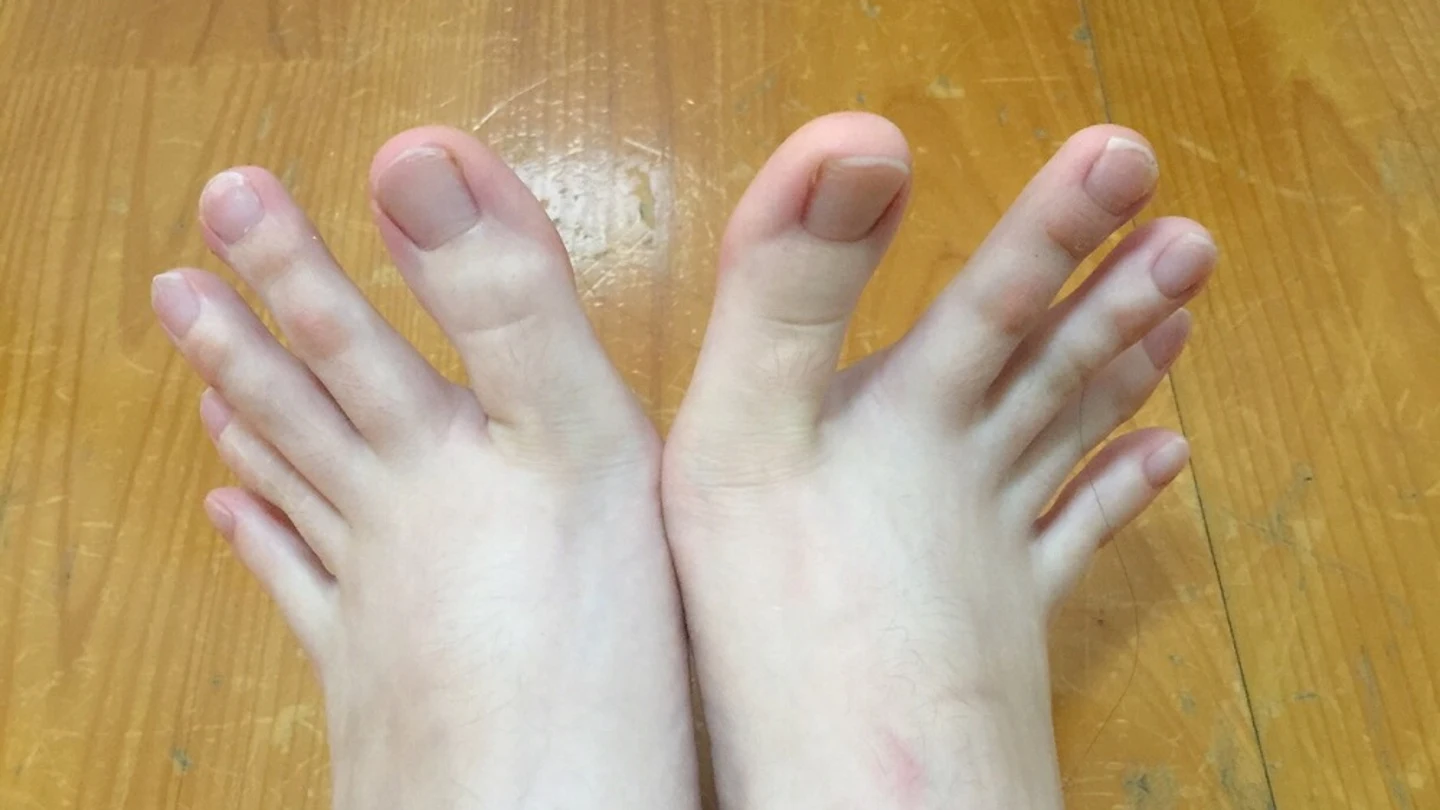 La extraña forma de los pies de una joven se vuelve viral La extraña forma de los pies de una joven se vuelve viral