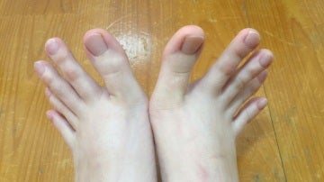 La extraña forma de los pies de una joven se vuelve viral