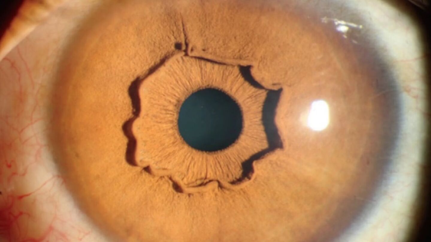 Una extra&ntilde;a forma que sobresale del iris de una mujer china. 