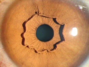 Una extraña forma que sobresale del iris de una mujer china. Una extraña forma que sobresale del iris de una mujer china.