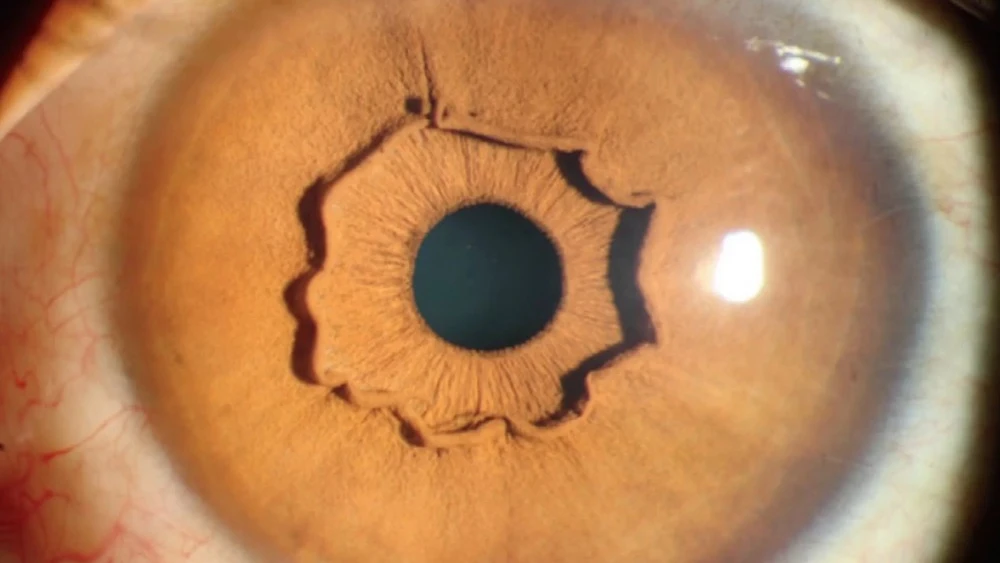Una extraña forma que sobresale del iris de una mujer china. 
