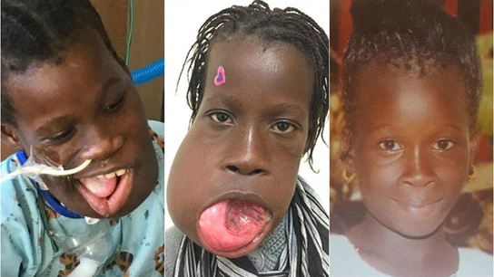 Una niña gamboina de 12 años salva su vida tras quitarse de su boca un tumor de tres kilos con la ayuda de una ONG Una niña gamboina de 12 años salva su vida tras quitarse de su boca un tumor de tres kilos con la ayuda de una ONG