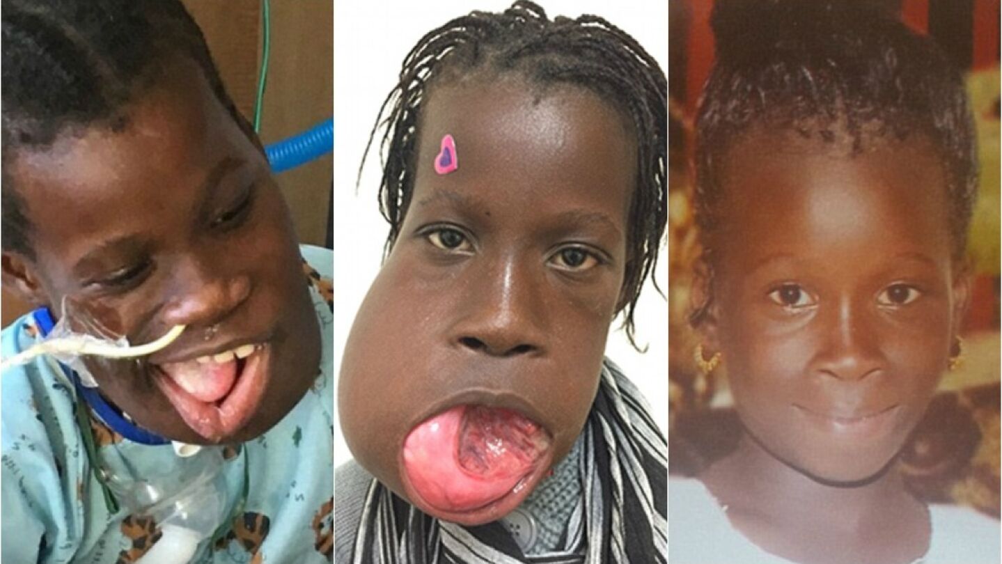 Una ni&ntilde;a gamboina de 12 a&ntilde;os salva su vida tras quitarse de su boca un tumor de tres kilos con la ayuda de una ONG