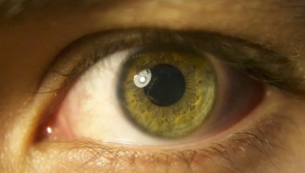 El desprendimiento de retina es más frecuente en personas mayores que se han vuelto miopes