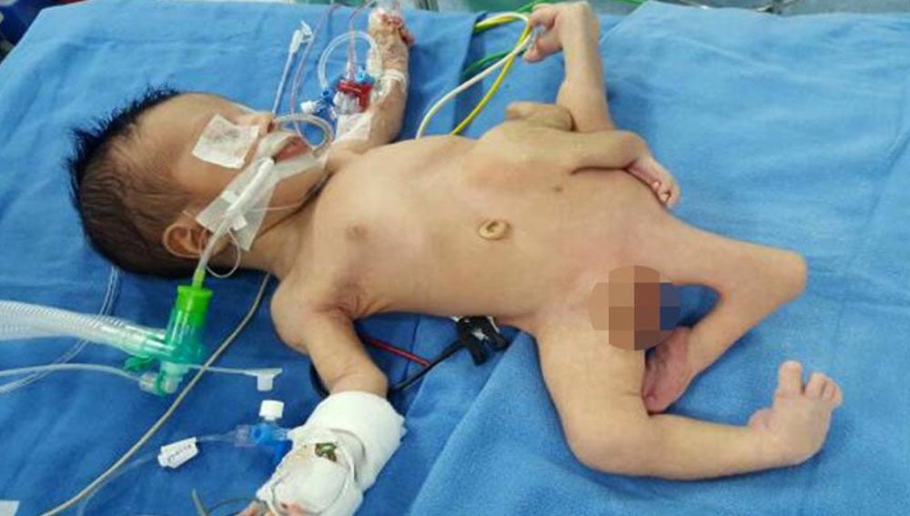 Bebé Iraquí con ocho extremidades