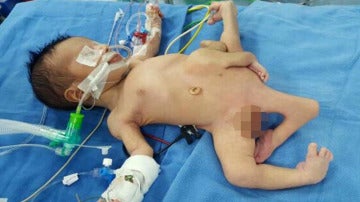 Bebé Iraquí con ocho extremidades