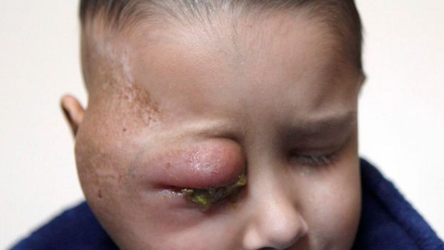 Un ni&ntilde;o de ocho a&ntilde;os sufre un tumor en el ojo derecho