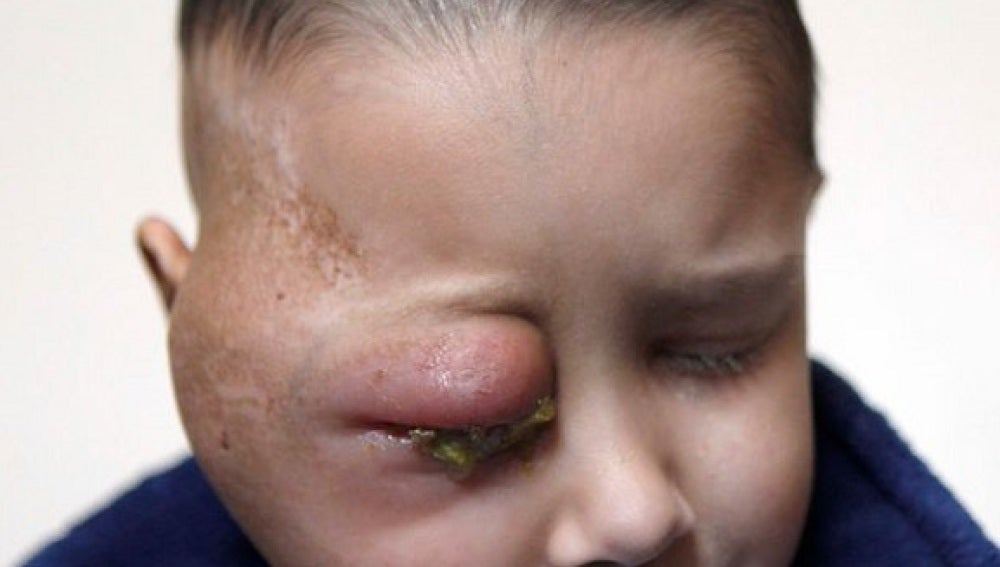 Un niño de ocho años sufre un tumor en el ojo derecho