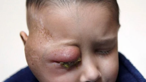 Un niño de ocho años sufre un tumor en el ojo derecho