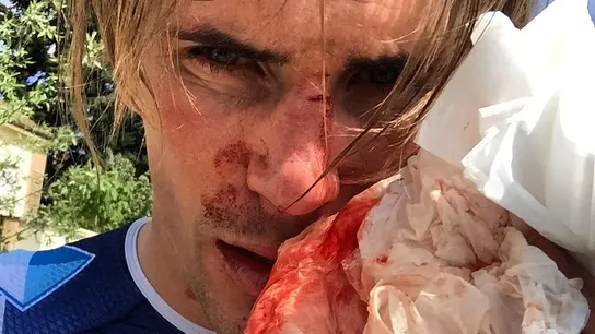 Yoann Offredo mostrando su cara ensangrentada tras ser agredido Yoann Offredo mostrando su cara ensangrentada tras ser agredido
