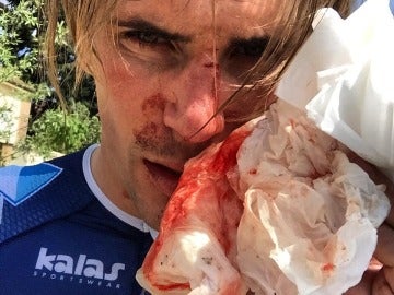 Yoann Offredo mostrando su cara ensangrentada tras ser agredido Yoann Offredo mostrando su cara ensangrentada tras ser agredido