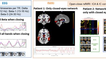 Analizar las alteraciones en las senales neuronales mejora el diagnostico de la epilepsia