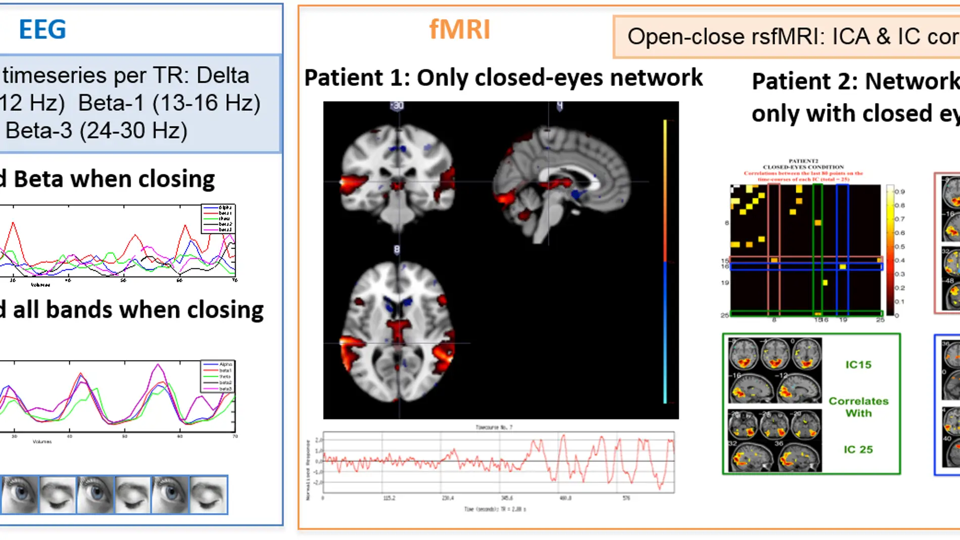 Analizar las alteraciones en las senales neuronales mejora el diagnostico de la epilepsia