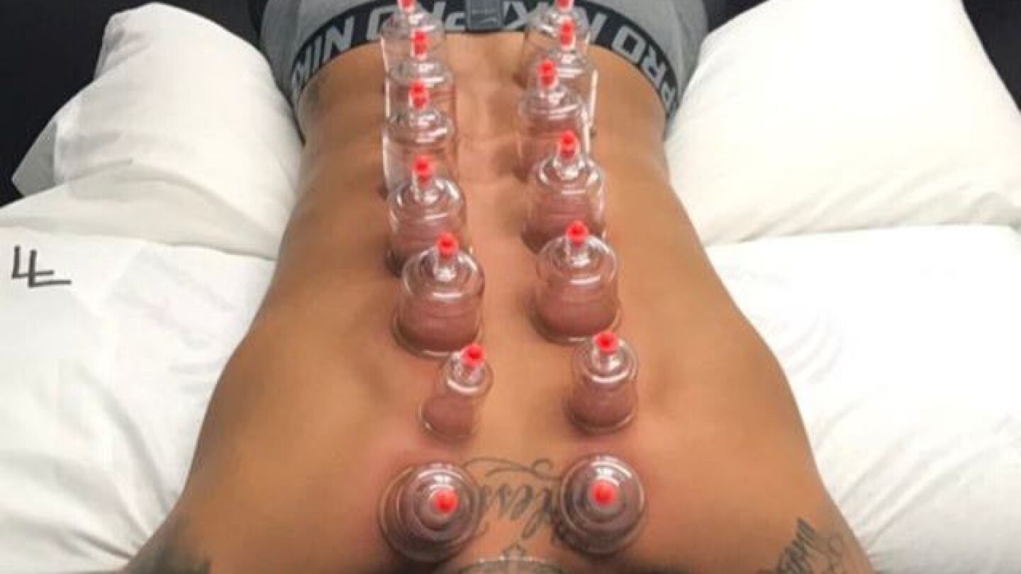 Neymar recibiendo el m&eacute;todo del 'Cupping'