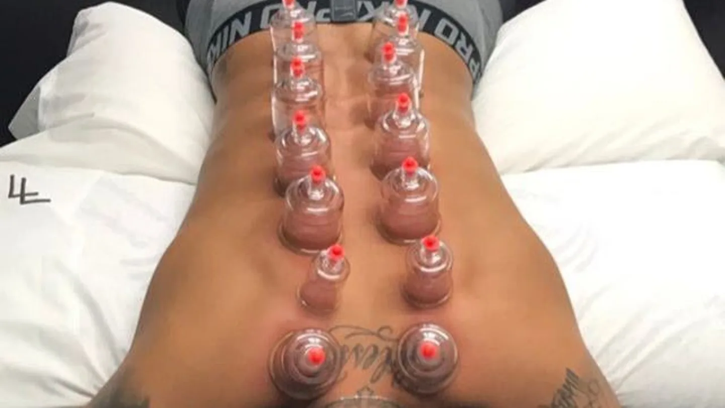 Neymar recibiendo el método del 'Cupping' Neymar recibiendo el método del 'Cupping'