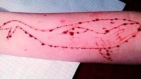 Brazo de un adolescente con lesiones dibujando una ballena Brazo de un adolescente con lesiones dibujando una ballena