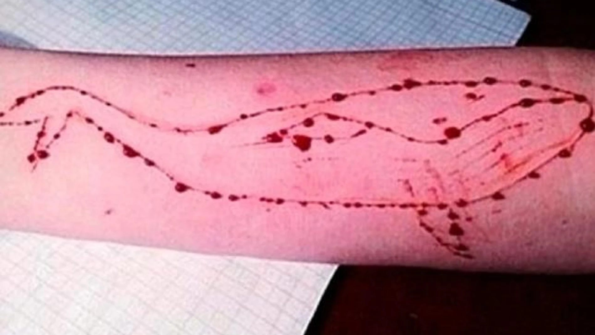 Brazo de un adolescente con lesiones dibujando una ballena