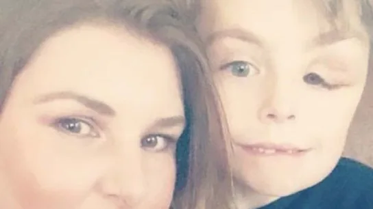 Koren Jeffcoate, un niño con 'enfermedad del hombre elefante' y su madre Koren Jeffcoate, un niño con 'enfermedad del hombre elefante' y su madre