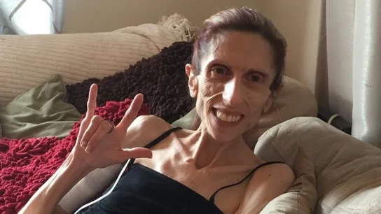 Rachael, la mujer de 39 años que pesa 20 kilos por la anorexia Rachael, la mujer de 39 años que pesa 20 kilos por la anorexia