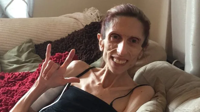 Rachael, la mujer de 39 años que pesa 20 kilos por la anorexia