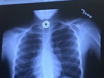Radiografía de la niña que muestra el Fidget Spinner Radiografía de la niña que muestra el Fidget Spinner