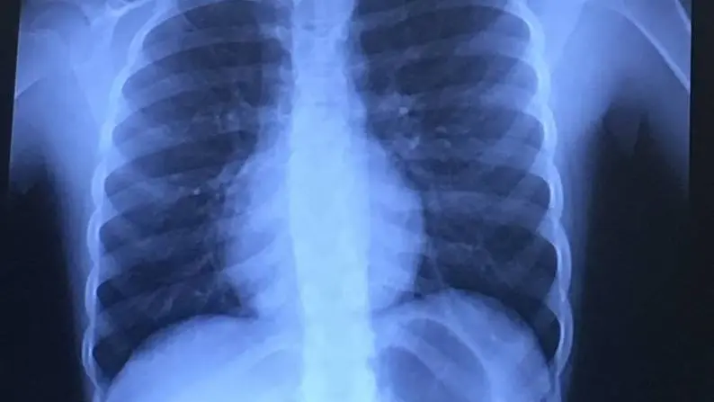 Radiografía de la niña que muestra el Fidget Spinner