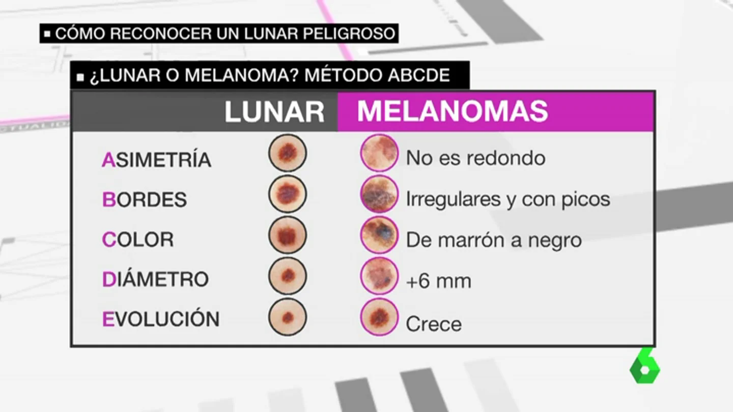Frame 34.95 de: melanoma Frame 34.95 de: melanoma