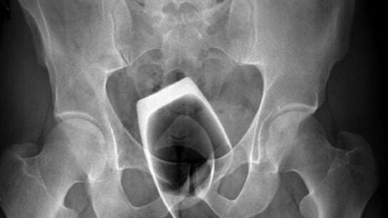 Le estalla un vaso en el cuerpo tras introducirlo por el ano