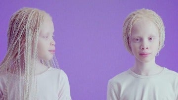 Lara y Mara Bawar, las gemelas albinas que causan furor en el mundo de la moda