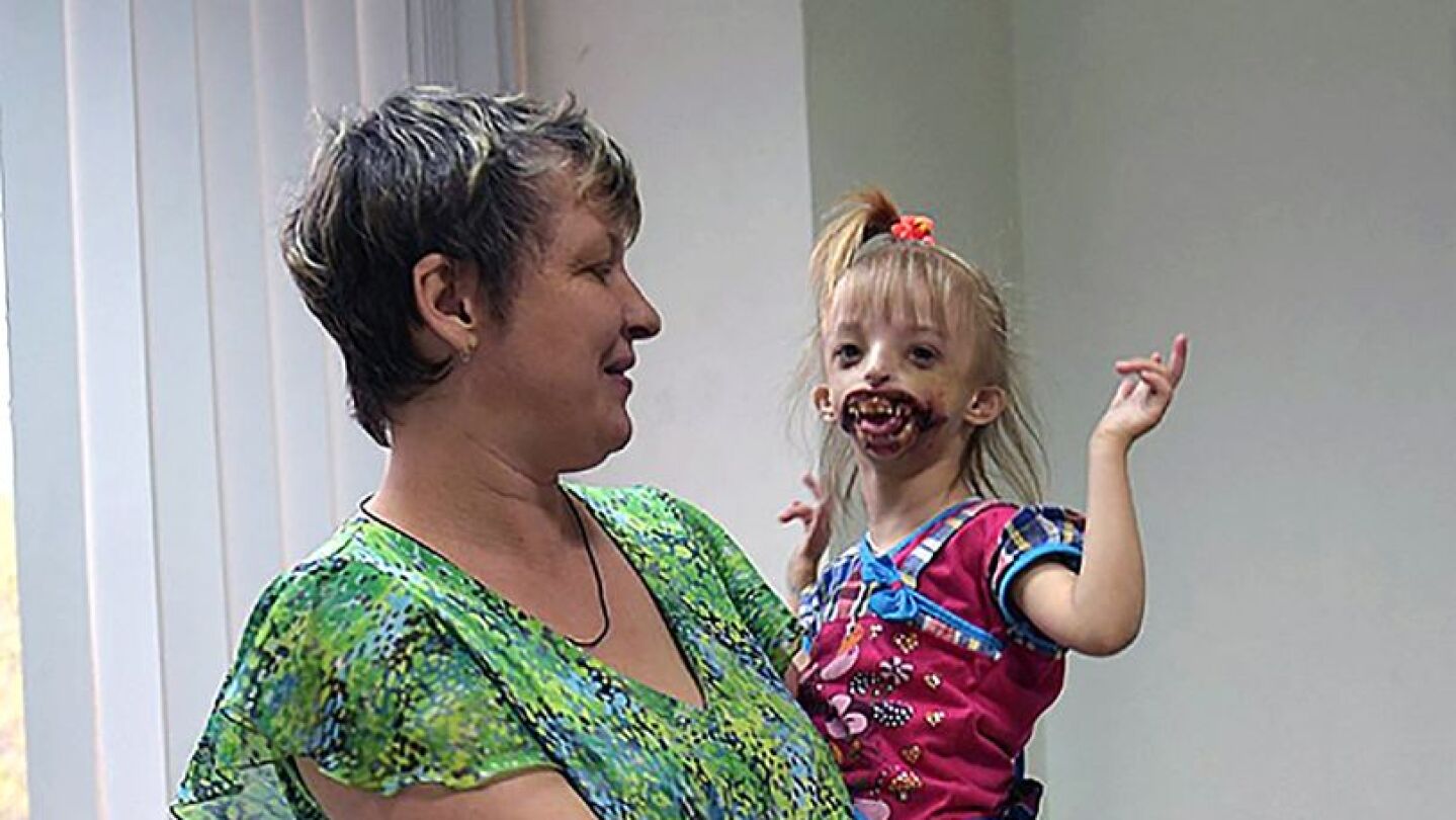 Darina, la ni&ntilde;a que sufre una extra&ntilde;a deformaci&oacute;n
