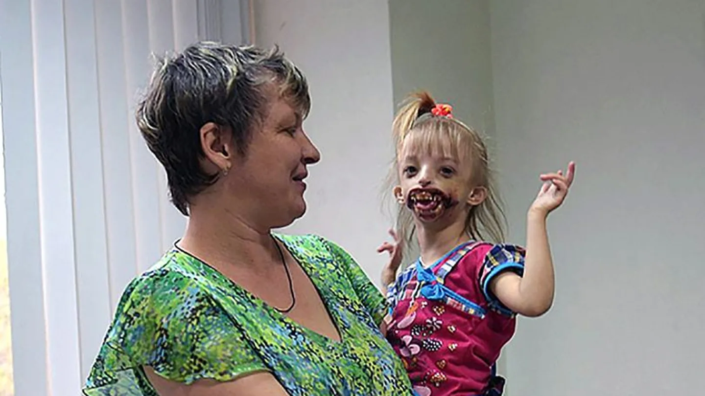 Darina, la niña que sufre una extraña deformación Darina, la niña que sufre una extraña deformación