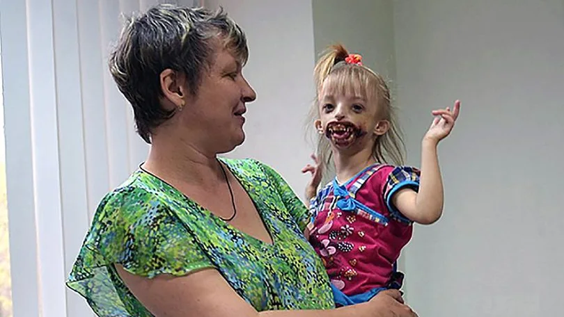 Darina, la niña que sufre una extraña deformación