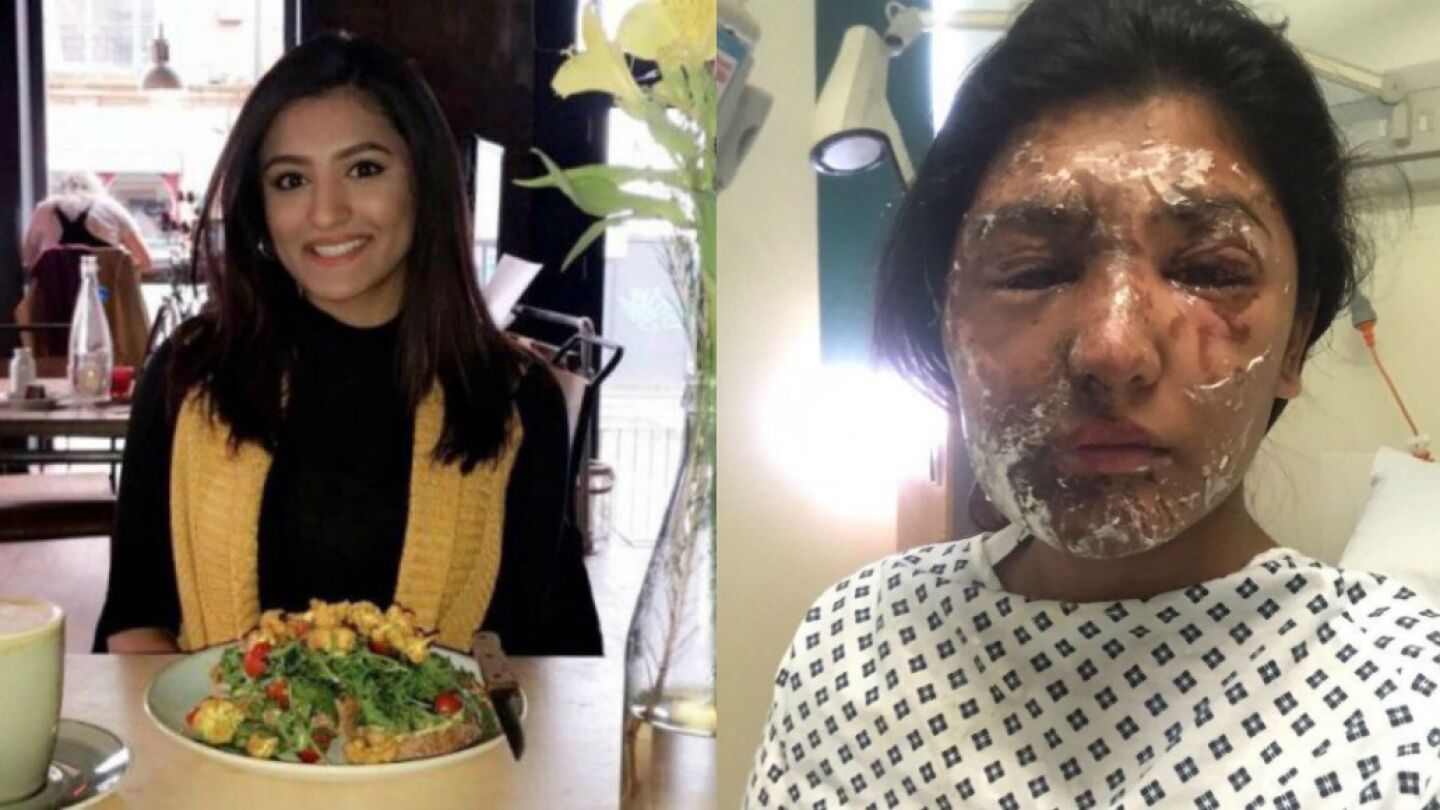 Resham Khan, antes y despu&eacute;s del ataque
