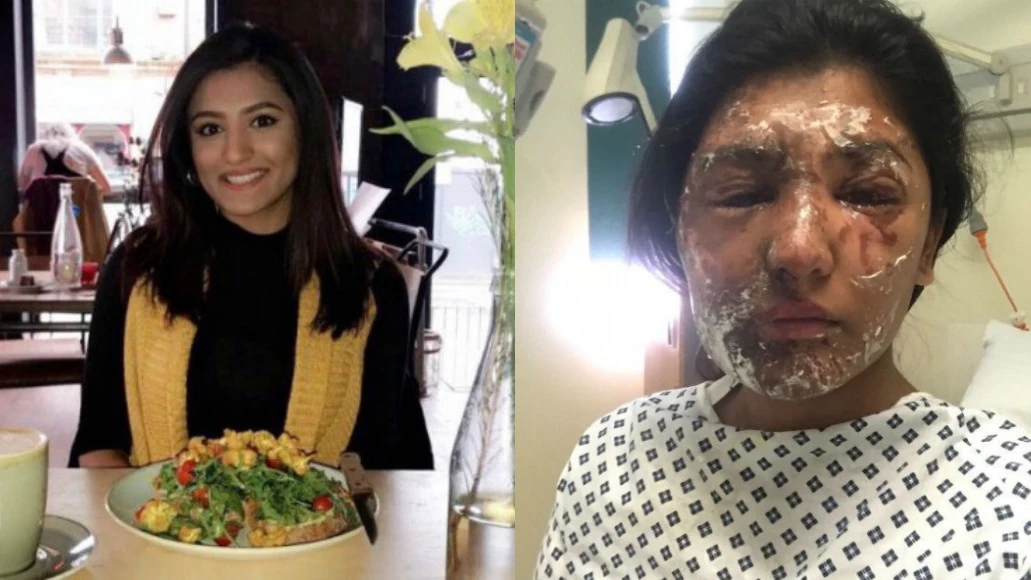 Resham Khan, antes y después del ataque Resham Khan, antes y después del ataque