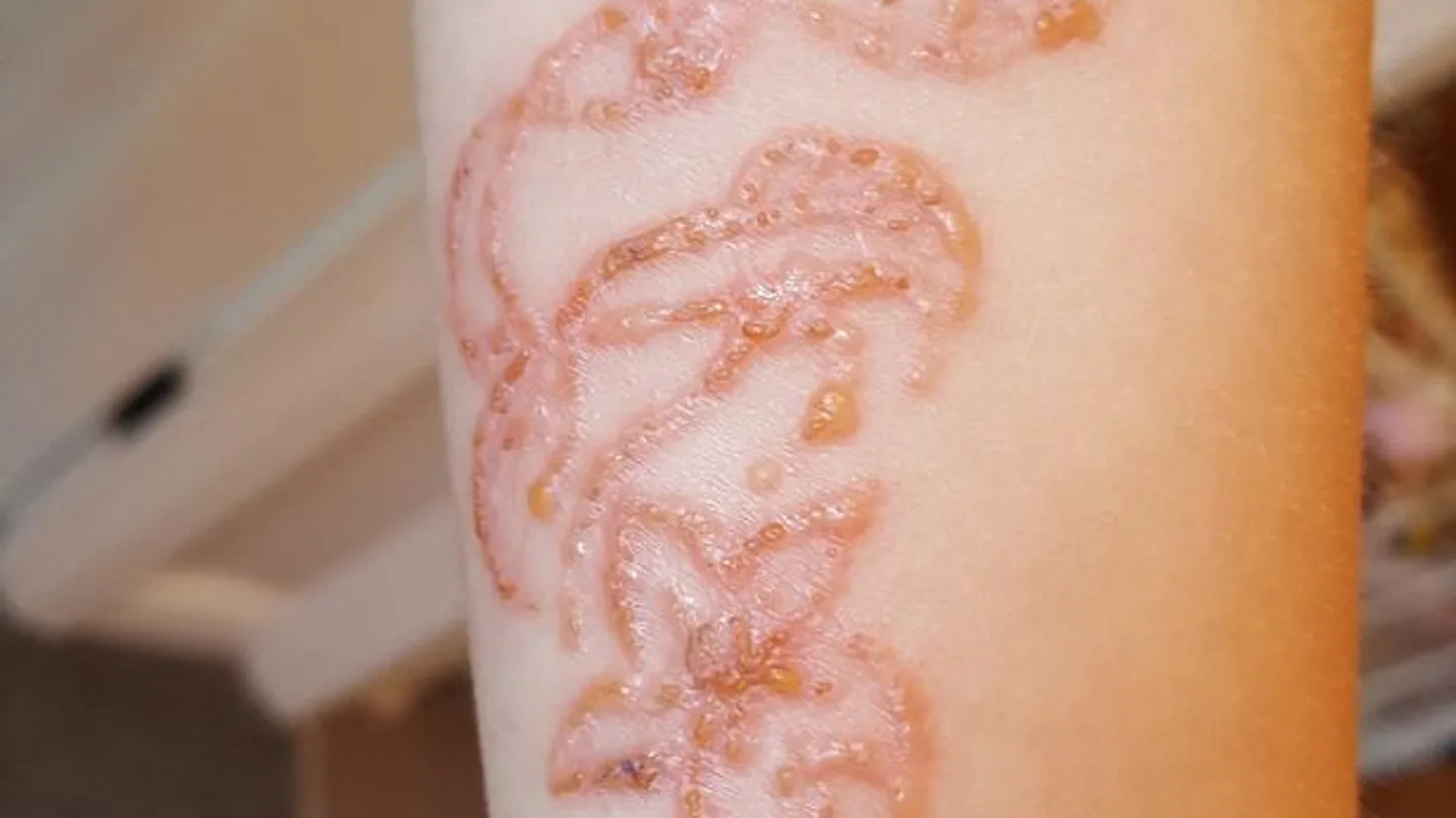 Se hace un tatuaje de henna y acaba con quemaduras Se hace un tatuaje de henna y acaba con quemaduras