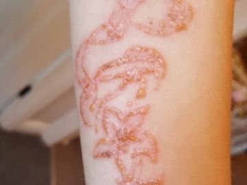 Se hace un tatuaje de henna y acaba con quemaduras Se hace un tatuaje de henna y acaba con quemaduras