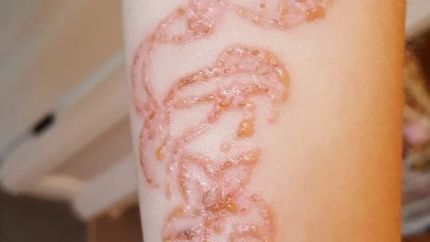 Se hace un tatuaje de henna y acaba con quemaduras 