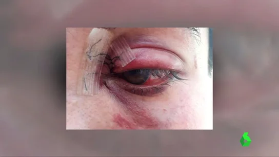 Heridas tras la brutal agresión por parte de su exnovio Heridas tras la brutal agresión por parte de su exnovio
